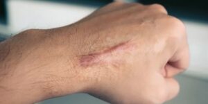 إحداث الندوب أولى المؤشرات لأعمال العنف لدى الشباب