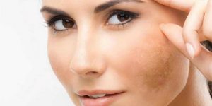 جمال وأناقة.. قناع مقاوم للكلف والبقع الغامقة