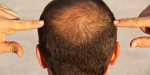 جديد الطب.. تليين خلايا بصيلات الشعر يعالج الصلع