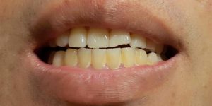 لا تفعلها- 5 عادات خاطئة تهدد أسنانك في الصيف