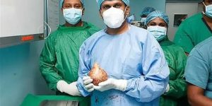 حجمها يقترب من كيلوغرام- إزالة أكبر حصوة كلى في العالم