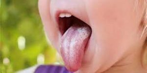 جديد الطب.. تورم اللسان عند الأطفال – إلى ماذا يشير؟