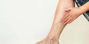 جلطات الأوردة بعد الولادة.. أسبابها وطرق الوقاية منها