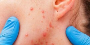 تعديل بكتيريا مسؤولة عنه وراثيا.. علاج جديد لحبّ الشباب