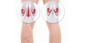 دوالي أوردة الساقين…. مضاعفات جديدة