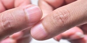 تظهر على الأظافر.. علامة تحذيرية تكشف إصابتك بمرض كبدي خطير