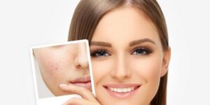 نصائح جمالية.. إخفاء حبوب الوجه بالماكياج