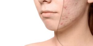 الندبات الجلدية.. كيف نمنع تشويهها لجمال البشرة؟