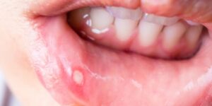 تزداد خطورة في فصل الشتاء.. تقرحات الفم قد تكون علامة تحذيرية